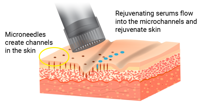 What is ProCell Microchanneling? - Ageless Aesthetics